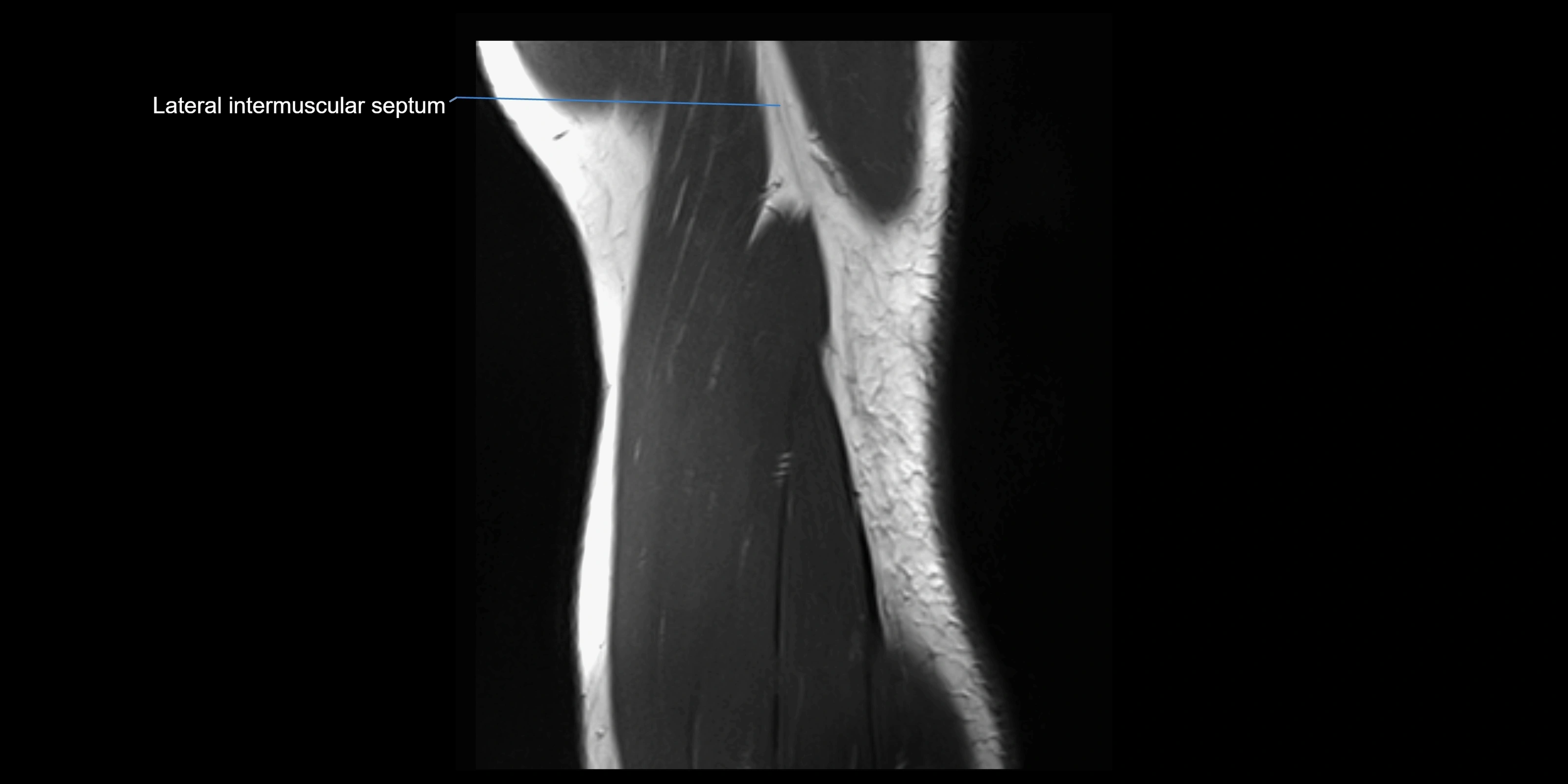 MRI elbow sagittal cross sectional anatomy 3T radiology  image-img-00001-00022.webp